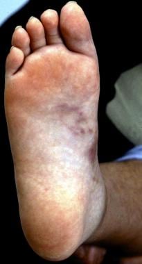 Nodules on sole of foot in cutaneous polyarteritis