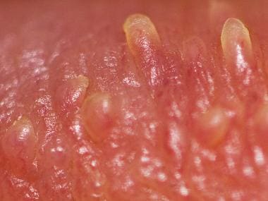 Pearly penile papules; close-up view. Courtesy of 