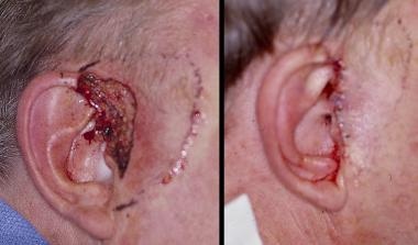 Preauricular advancement. Panel A: Defect on the h