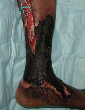 Patient with an ischemic wound of left lower extre
