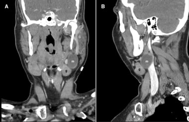 Second branchial cleft cyst. Coronal (A) and sagit