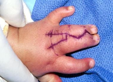 Dorsal view of hand of 1-year-old patient with com