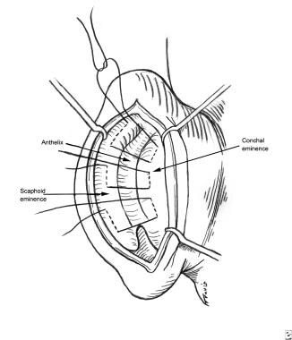 Mustarde (scapha-concha) sutures produce or increa