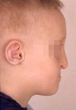 Young boy with bilateral cleft lip and palate who 