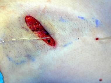 Surgical treatment of axillary hyperhidrosis. Modi