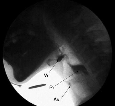 Lateral projection of the videoprint of a videogra