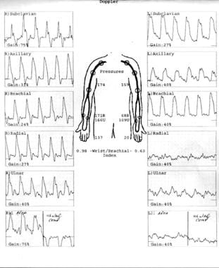 Normal results on right upper extremity Doppler ex