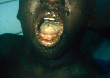 Boy with monkeypox in Democratic Republic of the C