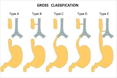Esophageal atresia classification according to Gro