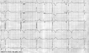 Complete heart block as seen in a patient with neo