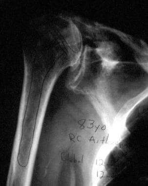 Radiograph demonstrating superior migration of the