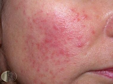 Mild papules and erythema. Courtesy of DermNet New