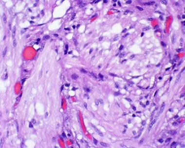 Pathology of Expansile Astrocytomas. Higher power