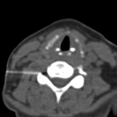 CT fluoroscopic image from a cervical nerve root b