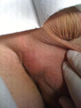 abscess in groin area pictures