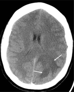 Brain abscess. Axial CT scan in a patient who pres