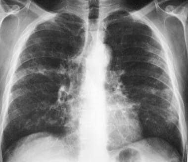 Posteroanterior (PA) chest radiograph in a patient