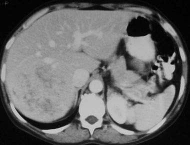 Contrast-enhanced computed tomography scan in the 