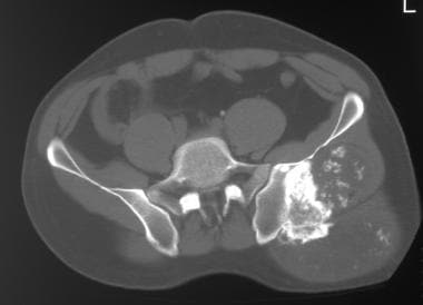 CT scan of the pelvis demonstrates a large soft-ti