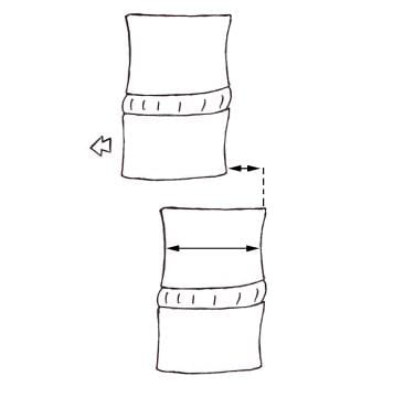 Spondylolisthesis. Diagram shows how to grade spon