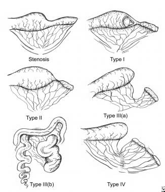 Classification of jejunoileal atresias. 
