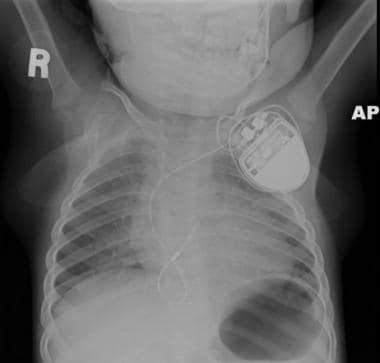 What are the possible risks after pacemaker surgery?