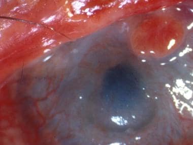 A patient with severe eye involvement associated w