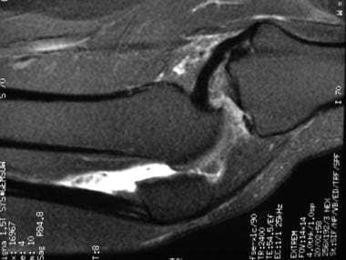 Sagittal T2-weighted MRI through knee in adult wit