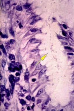 Helicobacter Pylori Infection. This image shows an