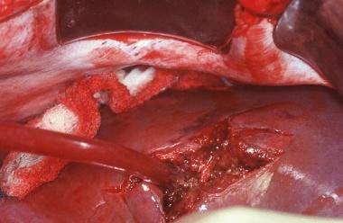This liver injury was sustained by the patient sho