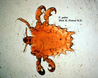 The pubic louse, Pthirus pubis, is identified by i