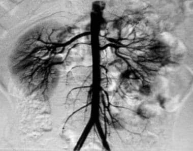 Aortogram of 4-year-old child with renovascular hy