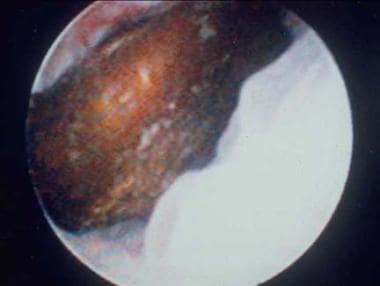 Distal ureteral stone observed through a small, ri