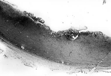 Photomicrograph shows the cyst wall, with inflamma