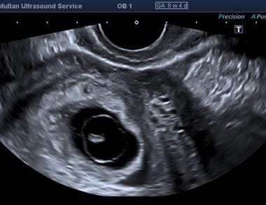 Dit was een zwangerschap van 8 weken volgens data, scan toonde