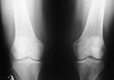 Osteoarthritis of the bilateral knees, Kellgren-La