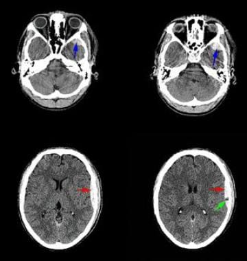 Axial nonenhanced computed tomography scans shows 