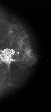 Imaging Of Benign Breast Calcifications Overview Mammogram