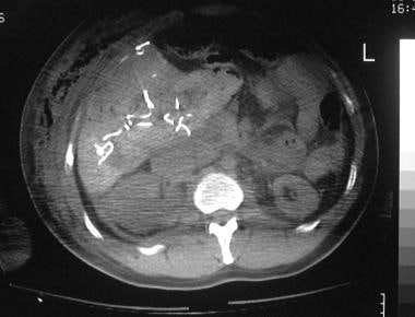 Grade 5 injury in a 36-year-old man who was involv