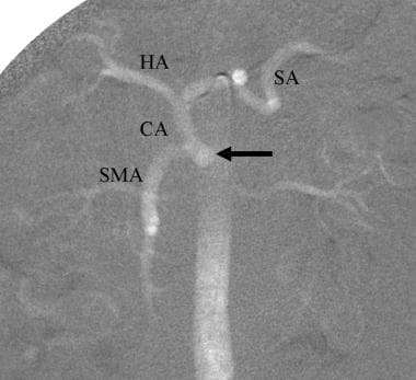 CO2 aortogram demonstrates celicomesenteric trunk,