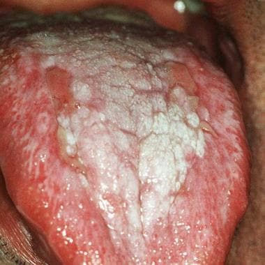 Ulcerative oral lichen planus on the dorsum of the