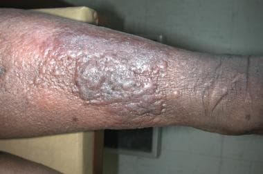 Lymphedema in a patient with hypertension, diabete