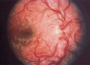 The dilated and abnormal retinal vasculature chara