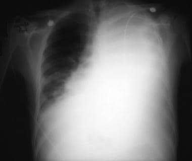 This anteroposterior upright chest radiograph show