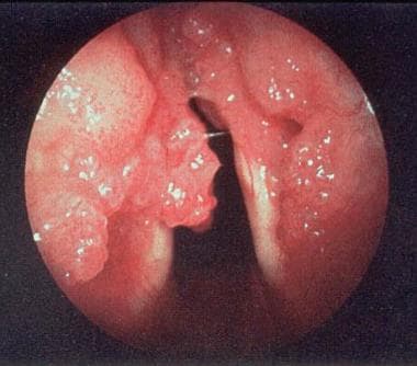 A 48-year-old woman presents with inspiratory stri