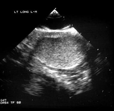 This scrotal sonogram shows a healthy testis. 