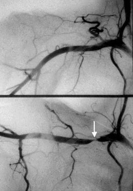Angiogram of upper extremity. Top is in normal pos