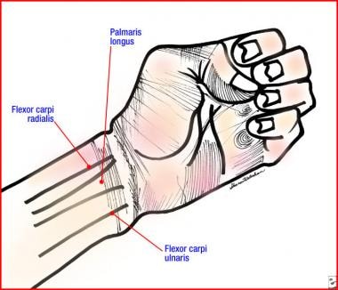 Volar tendons at the wrist. These can be used as l