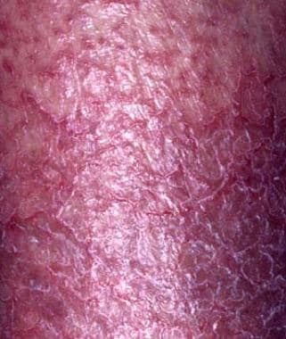 Dry, fissured, pruritic eczema is frequently the r