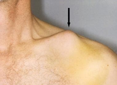 Close-up view of clavicle tenting the skin (arrow)